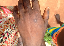 Preventing skin infections would solve other major health problems in remote communities