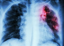 Explainer: what is TB and am I at risk of getting it in Australia