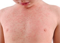 Emerging cases of measles in people who have been vaccinated